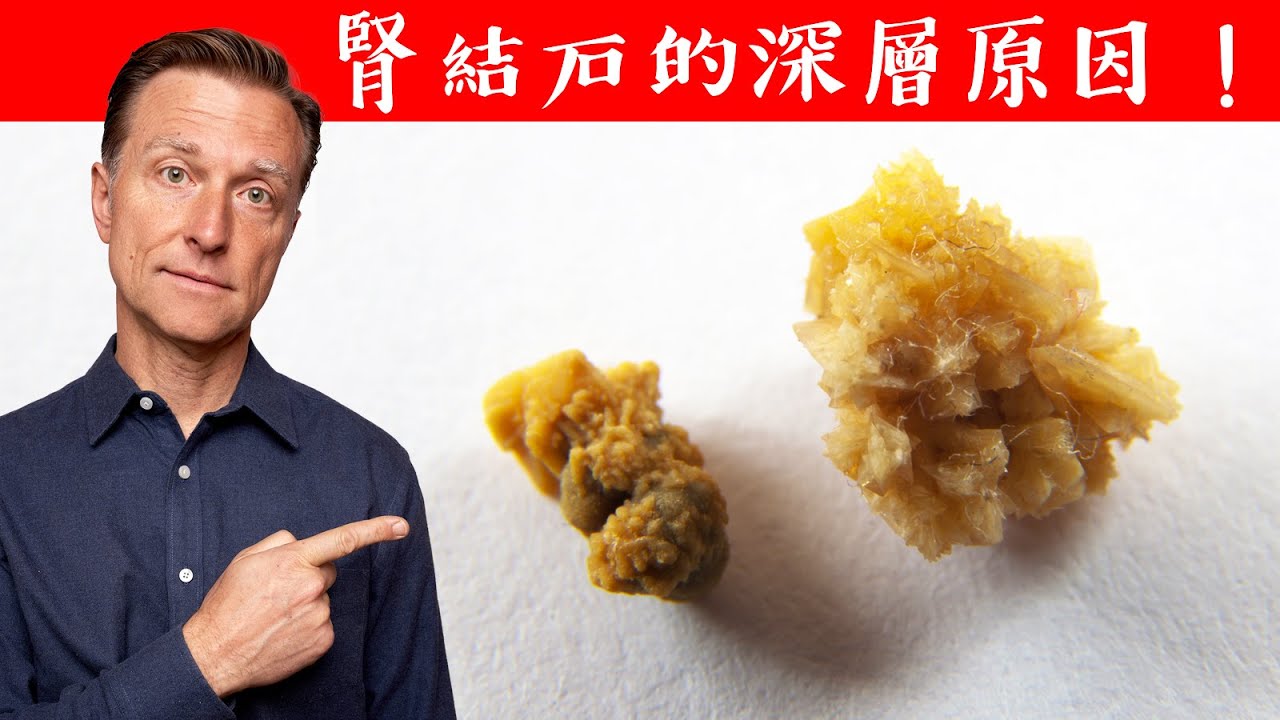 腎結石與各種鈣化,人不知的深層原因,自然療法柏格醫生 Dr Berg