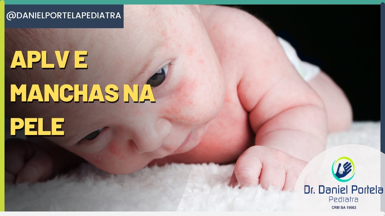 Manchas na pele pode ser APLV - alergia a proteína de leite de vaca