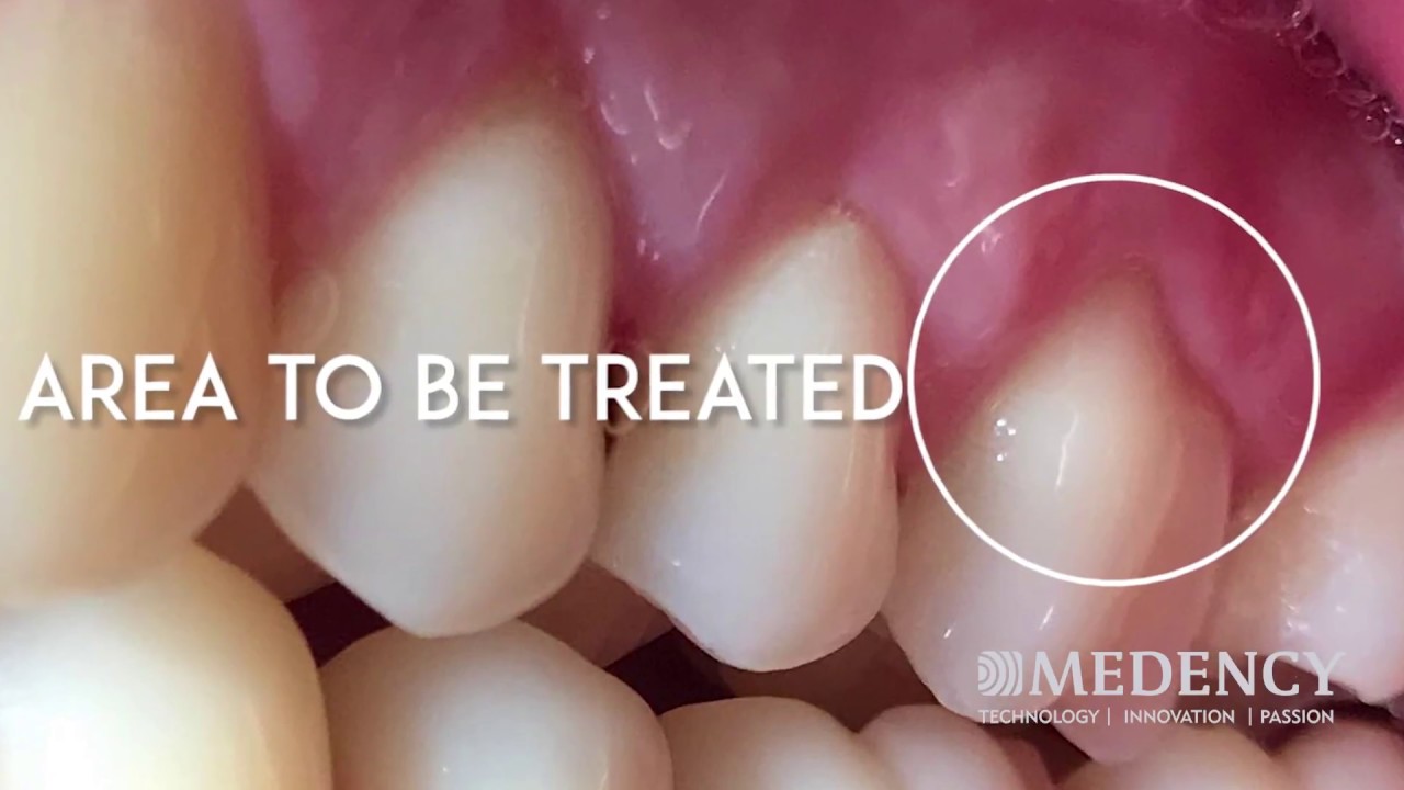 Medency  Primo Diode laser Desensitization