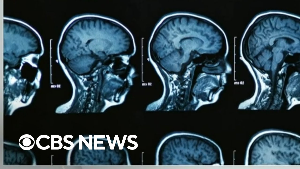 Experimental Alzheimer's drug may slow progression, but with significant side effects, study shows