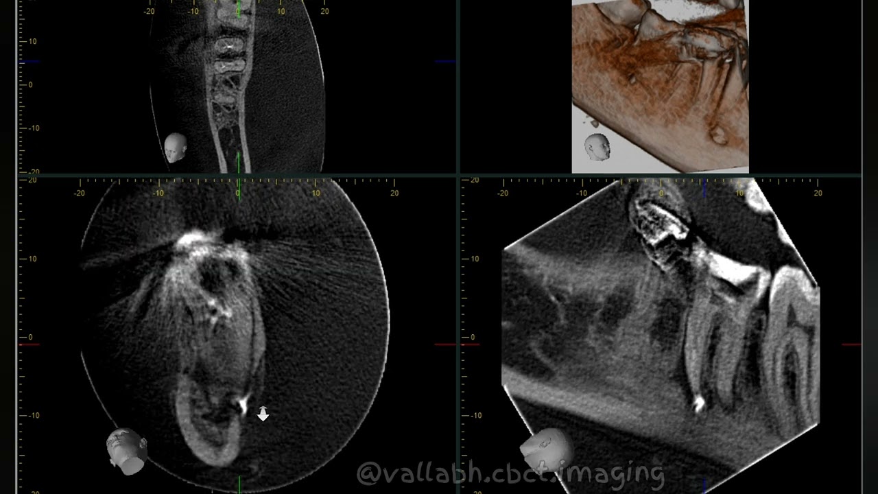 CBCT to detect ROOT CANAL OVERFILL