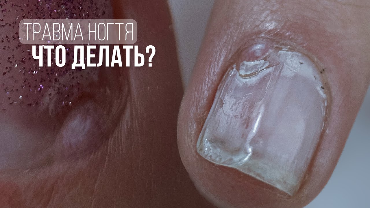ШИШКА НА КУТИКУЛЕ 🤕 ТРАВМА НОГТЯ: ЧТО ДЕЛАТЬ? ⛔️ ДВОЙНАЯ КУТИКУЛА ✨ СВЕТООТРАЩАЮЩИЙ АКРИГЕЛЬ