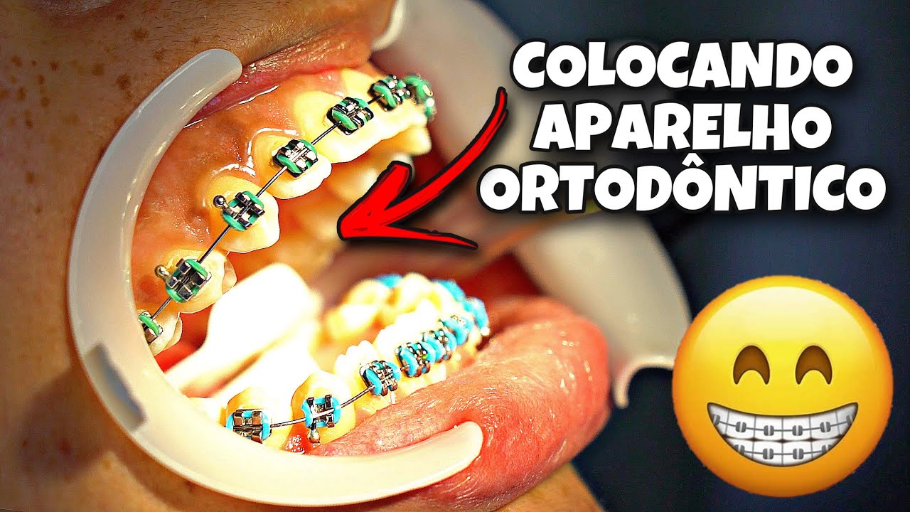 Instalação de aparelho ortodôntico fixo | braquetes metálicos