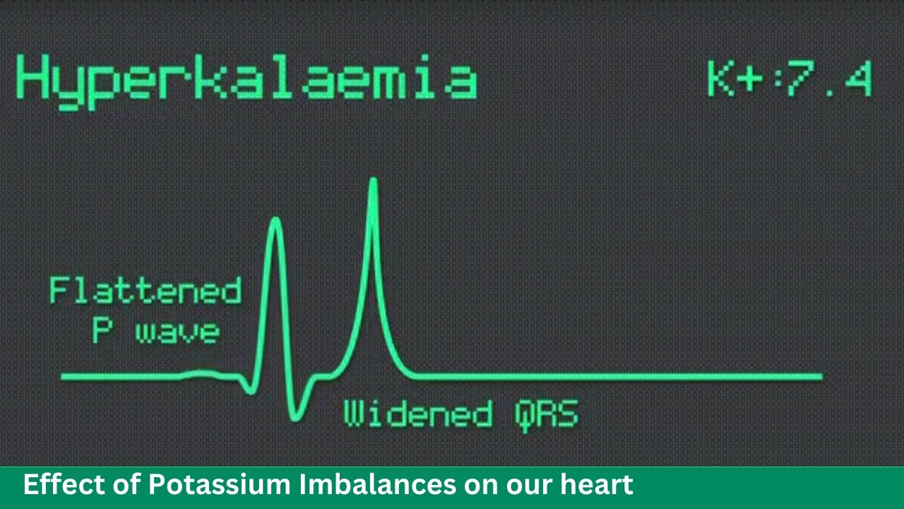 Master ECG: Spot Potassium Abnormalities from Hypo to Hyperkalemia