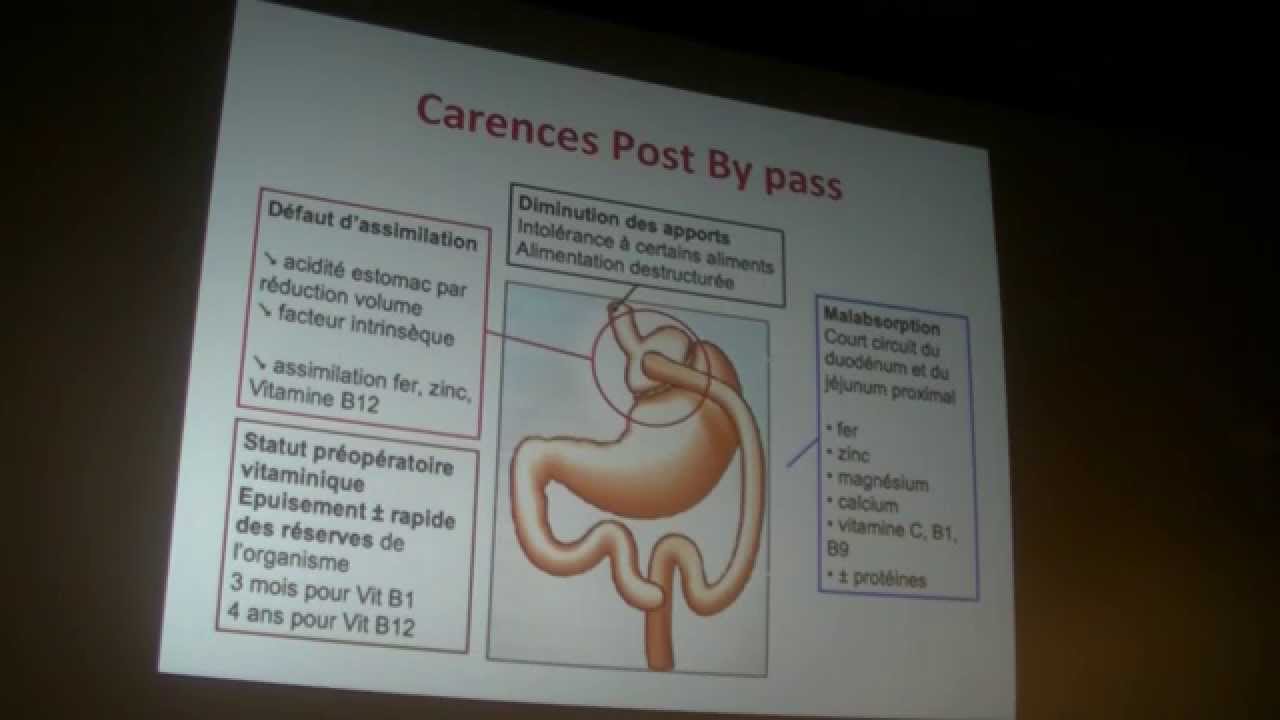 Les complications somatiques et Troubles du Comportement Alimentaire en chirurgie - Dr HANIFI