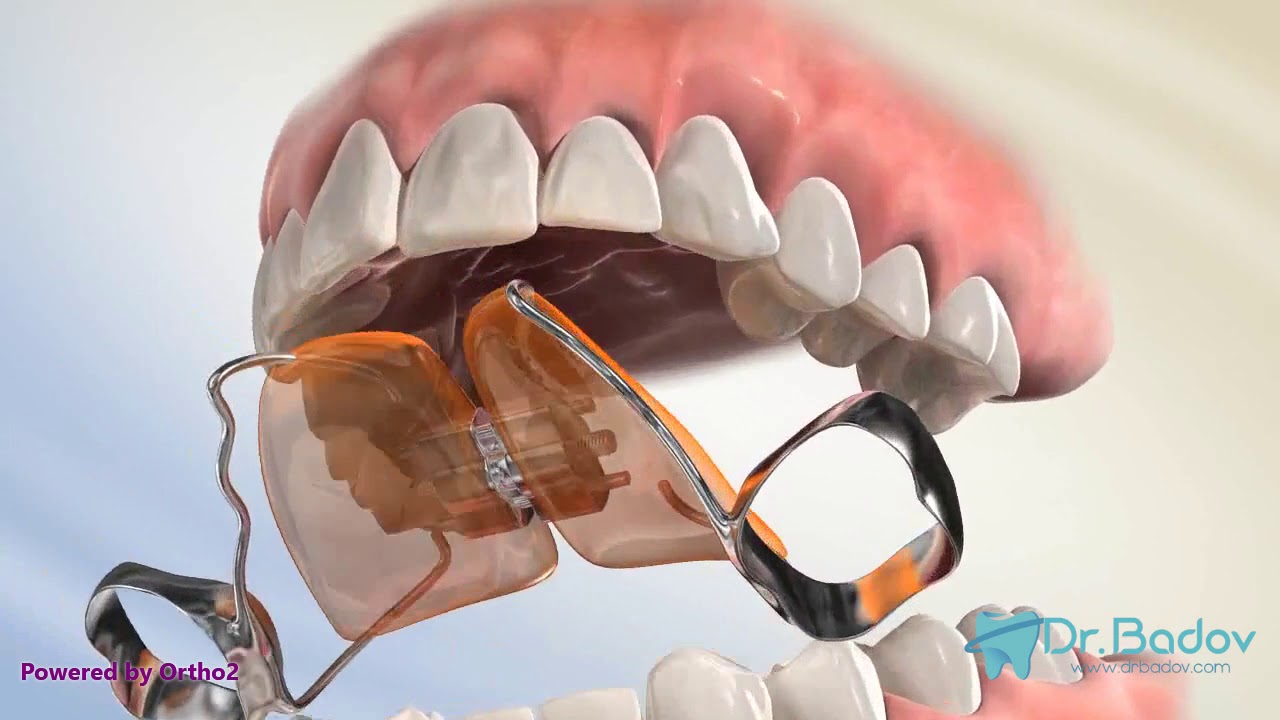 #ортодонт #брекети #ортодонтия Кръстосана захапка при дъвкателните зъби- какво е и как се лекува?