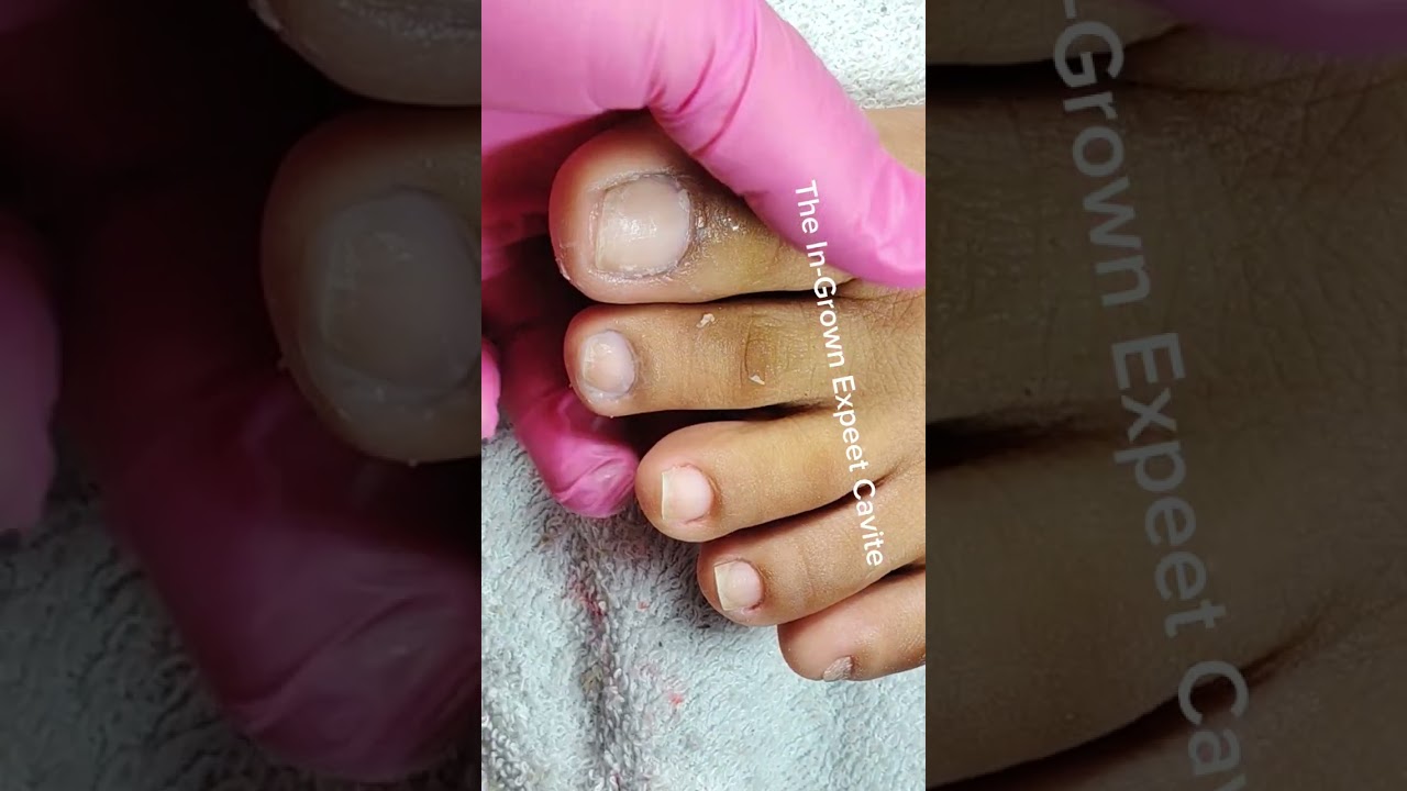 Full video pedicure with ingrown removal
