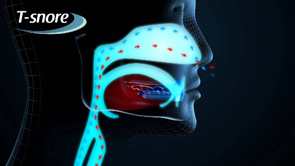 Tsnore | The solution for snoring problems
