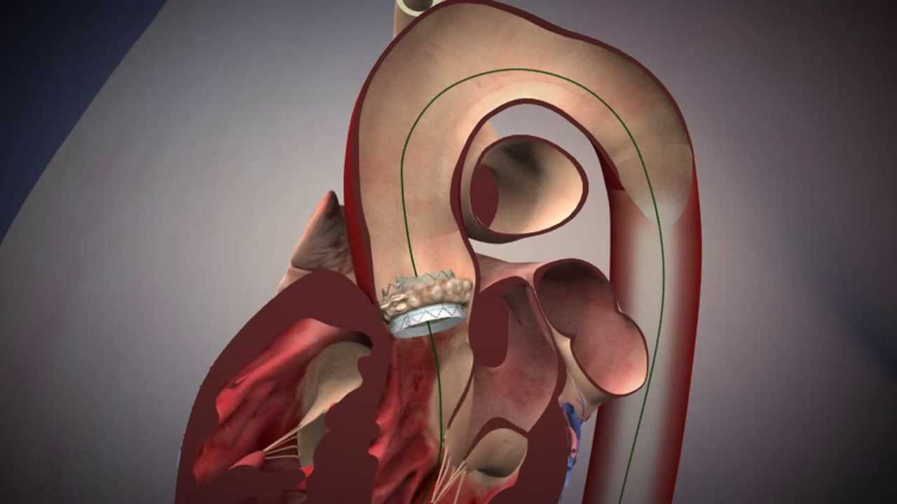 TAVR: Edwards, Sapien Aortic Valve Deployment