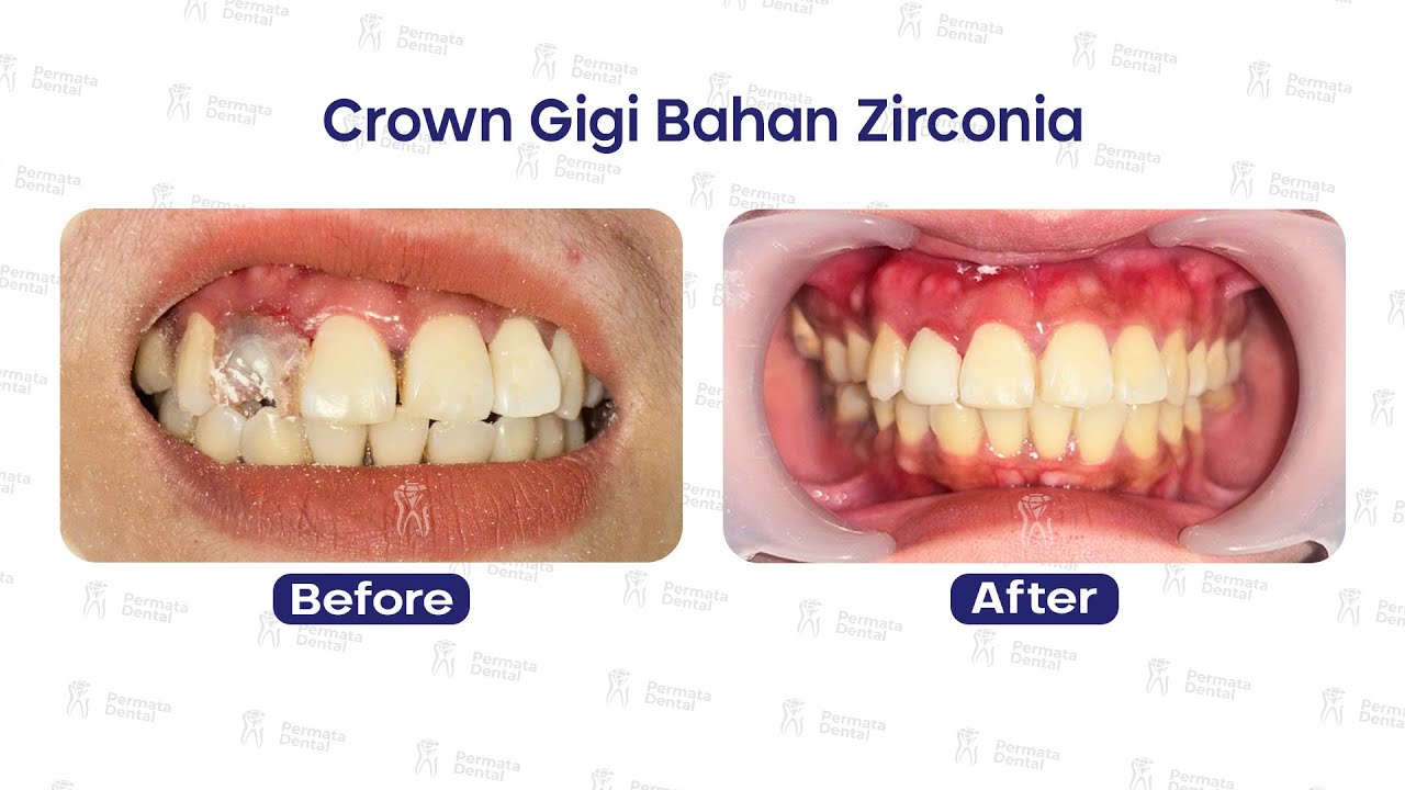 Proses Pembuatan & Pemasangan Gigi Crown Berbahan Zirconia di Permata Dental #2