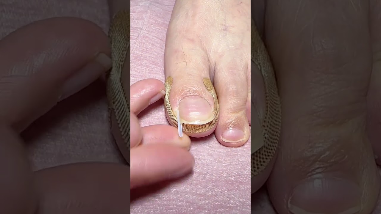 Doctor-Style Ingrown Toenail CorrectionPerfect Nail Alignment