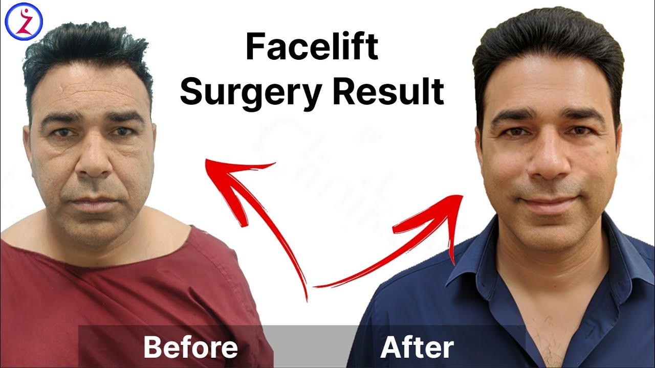 Facelift Surgery In Chandigarh | Cost OF facelift Surgery In Chandigarh | Zenith Clinic