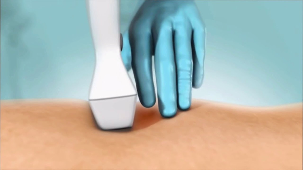 Adhesivo para el tratamiento de varices