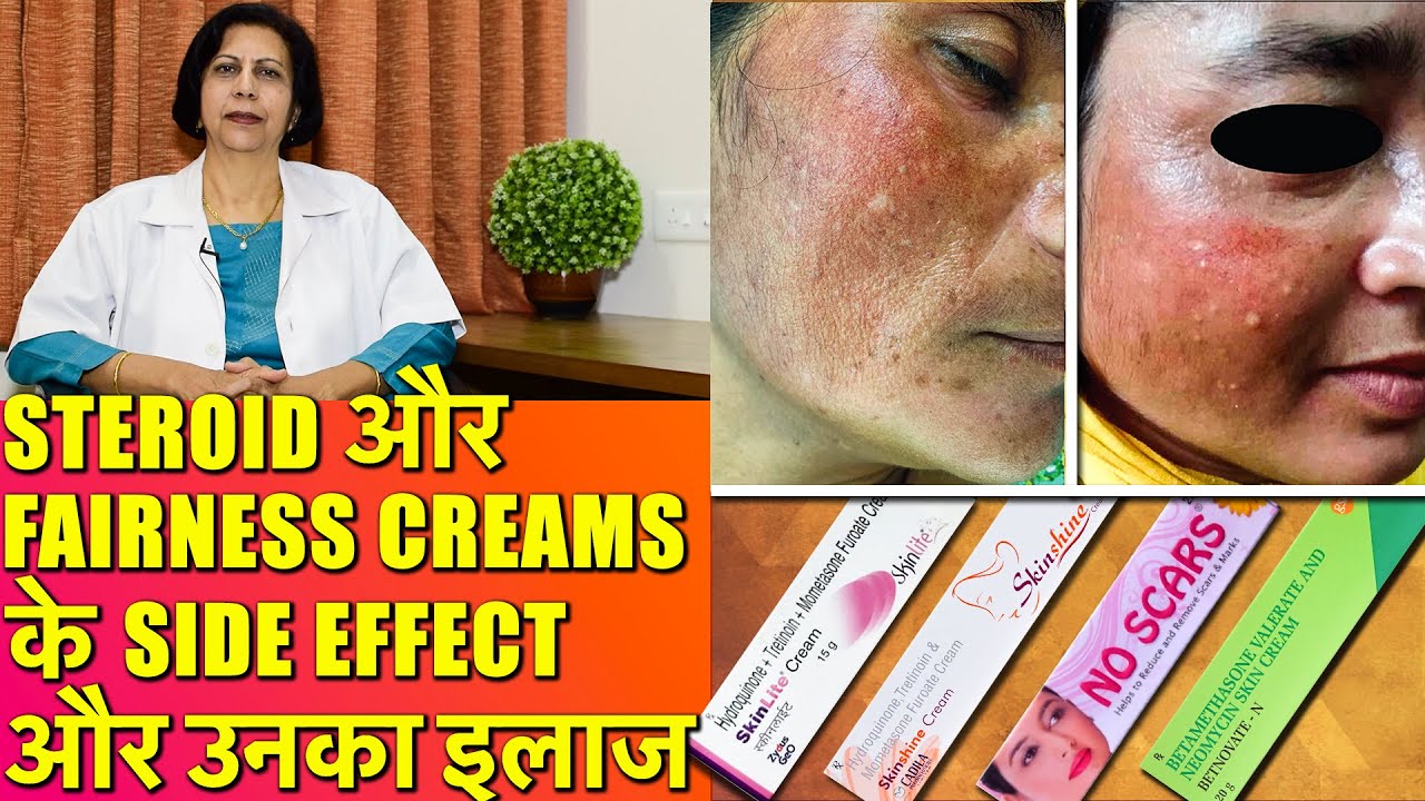 Steroid और Fairness Creams के Side Effects और उनका इलाज