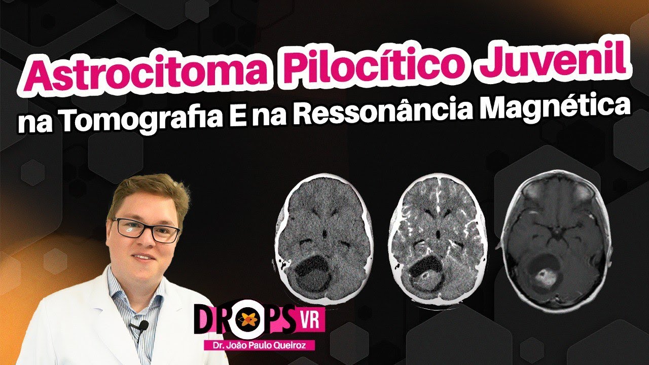 ASTROCITOMA PILOCÍTICO JUVENIL: COMO RECONHECER NA TC E RM? I VOCÊ RADIOLOGISTA