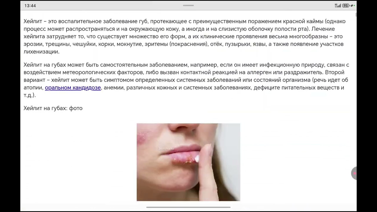 ТРЕСКАЮТСЯ ГУБЫ И ДРУГИЕ БОЛЕЗНИ