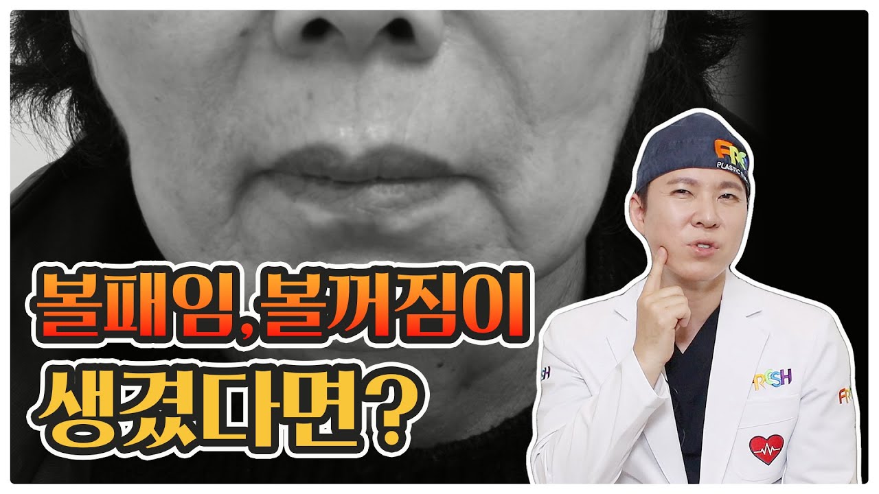 ★볼패임/볼꺼짐★ 땅콩처럼 변한 얼굴형 개선하는 방법ㅣ얼굴지방흡입 유착, 볼패임, 볼꺼짐으로 고통받지 마세요. 얼굴지방흡입 복원술/재수술ㅣ프레쉬성형외과X홍종현원장