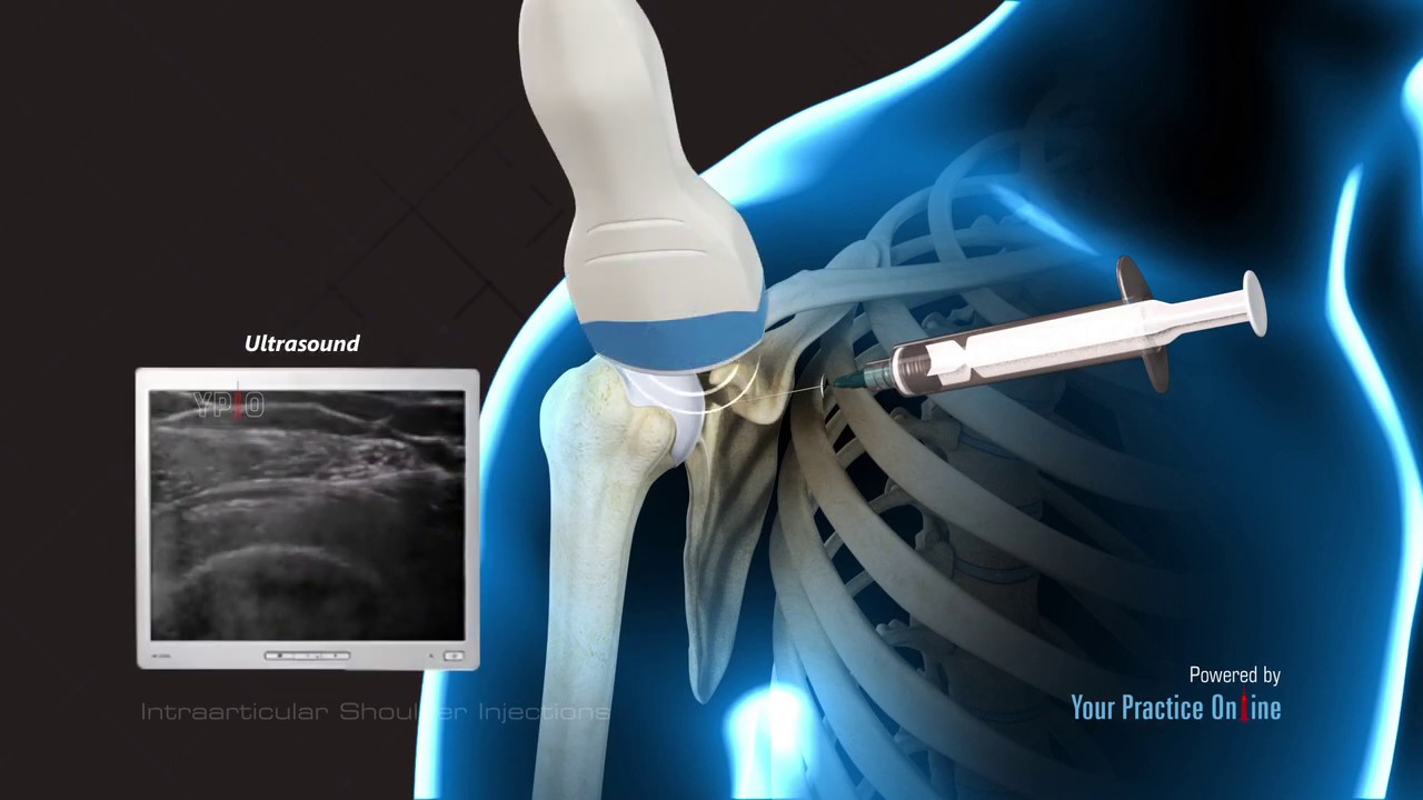 Intraarticular Shoulder Injection