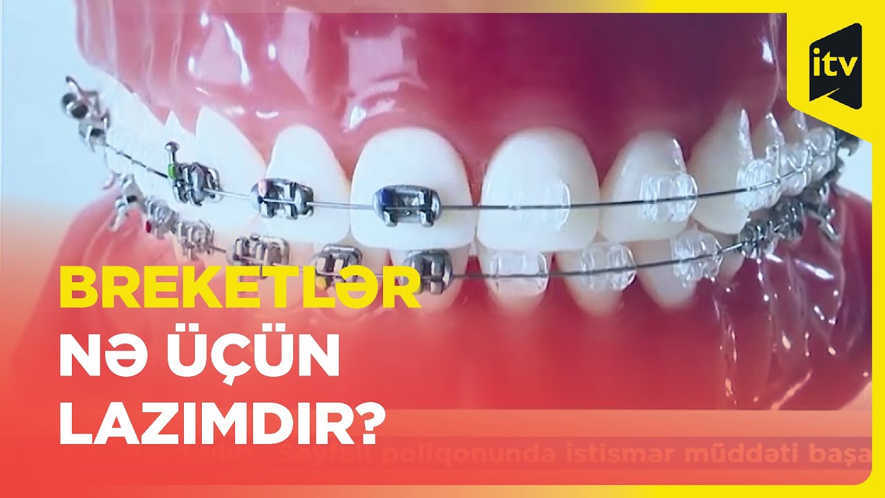 Uşaqların ağıl dişini çəkdirərkən, diqqətli olun!