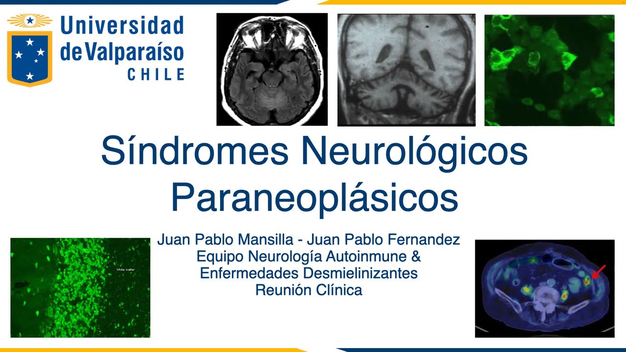 Síndromes Neurológicos Paraneoplásicos: Fenotipos de Alto Riesgo