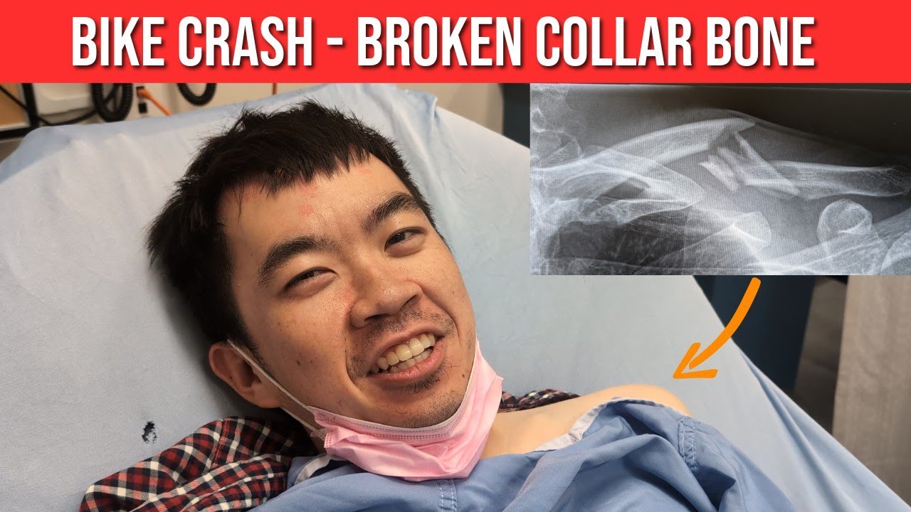 Road Bike Crash | Start of my Broken Clavicle Recovery Journey
