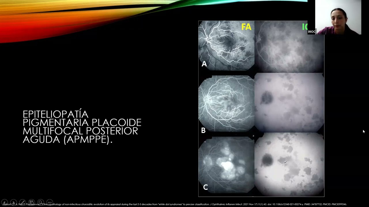 Inflamación Coroidea y retinal No infecciosa -  Dra. Gusmary Hernández