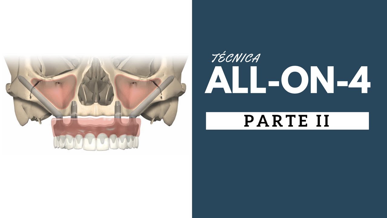 5. TÉCNICA ALL ON 4  - PARTE 2 -  Implantes Zigomáticos