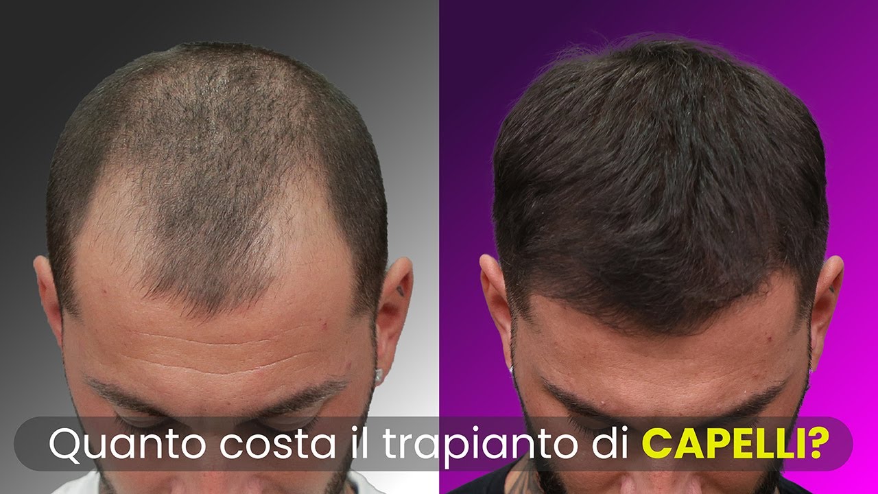 Quanto costa il trapianto di Capelli? Lo spiega il Dottor Skerdi Faria