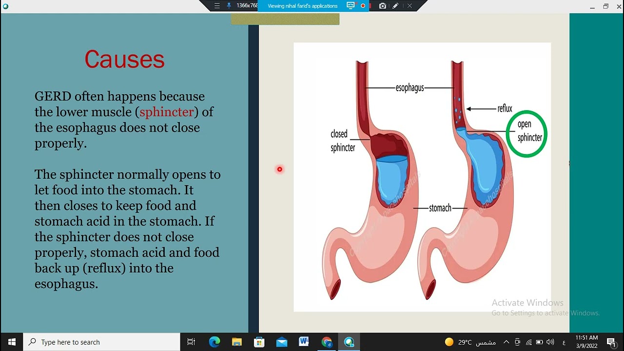Gerd Heart burn indigestion community pharmacy صيدلة المجتمع