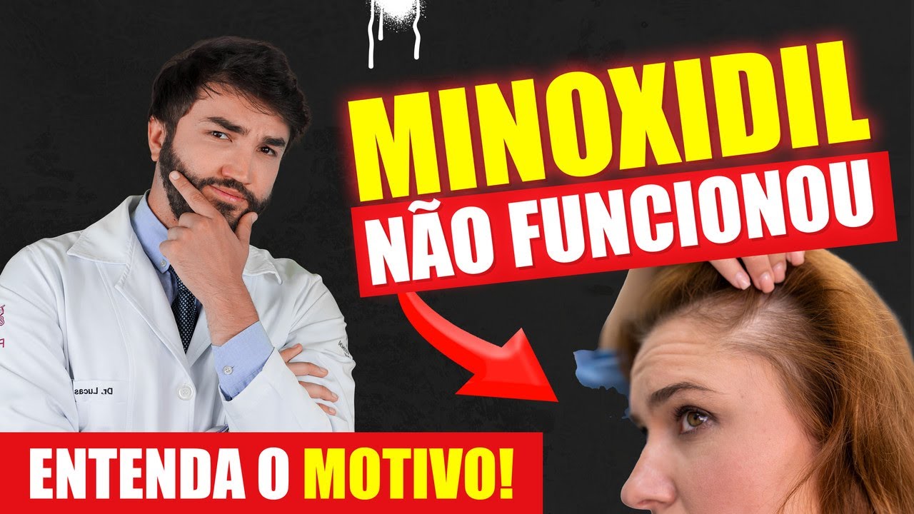 MINOXIDIL: Casos que NÃO FUNCIONAM!