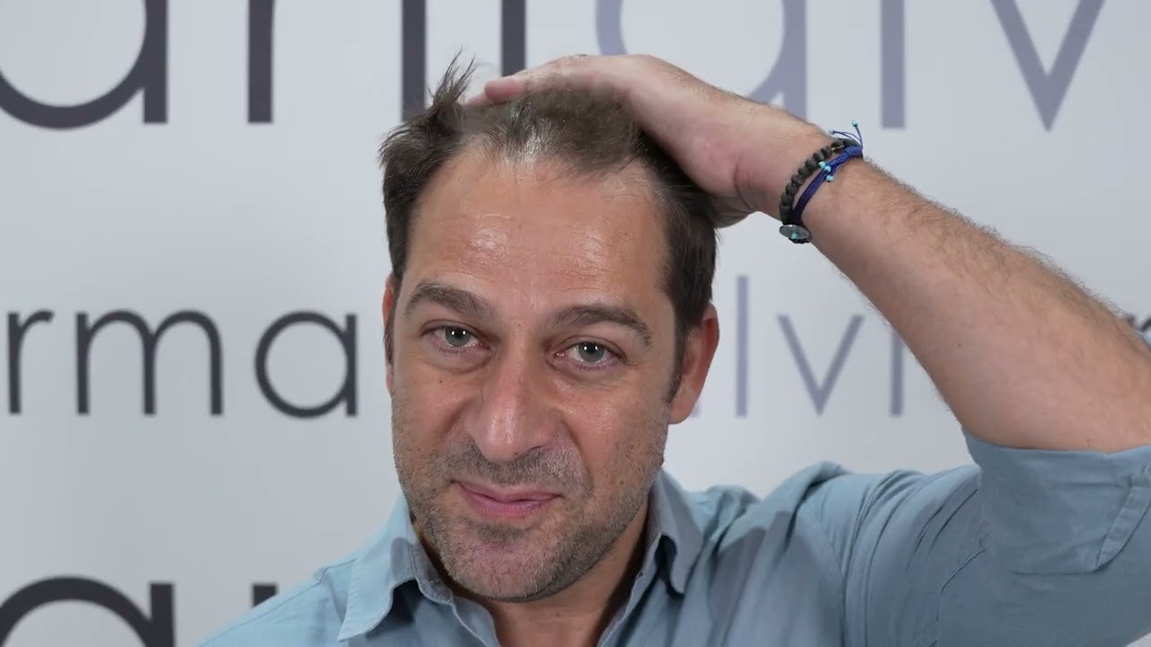 Emmanuel Castis - Alvi Armani Hair Transplant