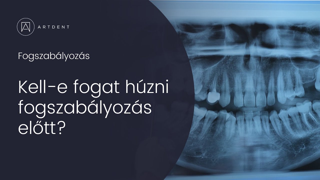 Kell-e fogat h&uacute;zni vagy nem fogszab&aacute;lyoz&aacute;s előtt? - Artdent Fog&aacute;szat