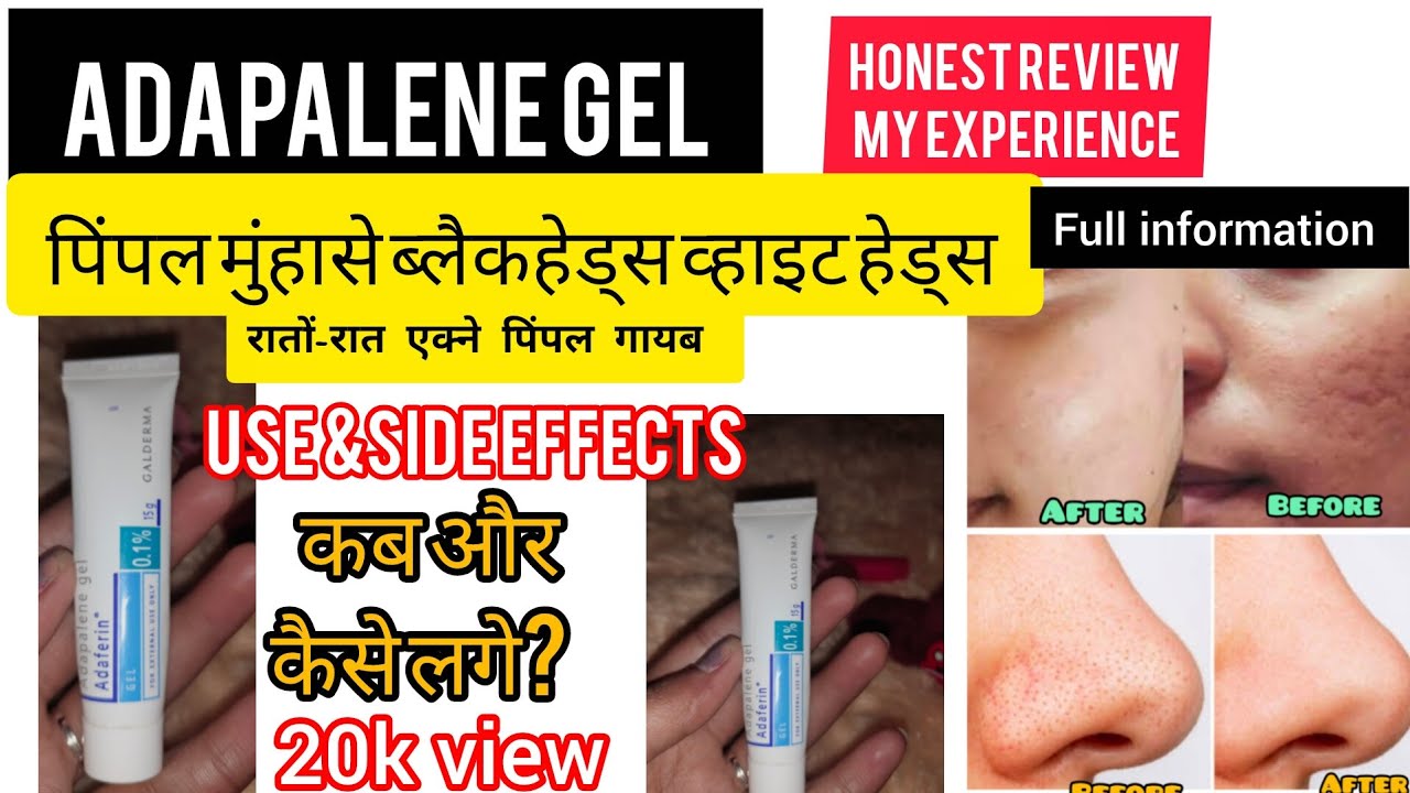 ADAPALENE GEL |ADAPALENE GEL 0.1% |HONEST REVIEW ✌️ HOW to use it 😱😱#trending #viral #acneproneskin 