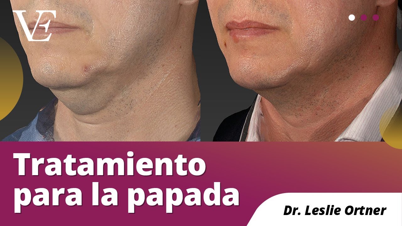 TRATAMIENTO PARA LA PAPADA