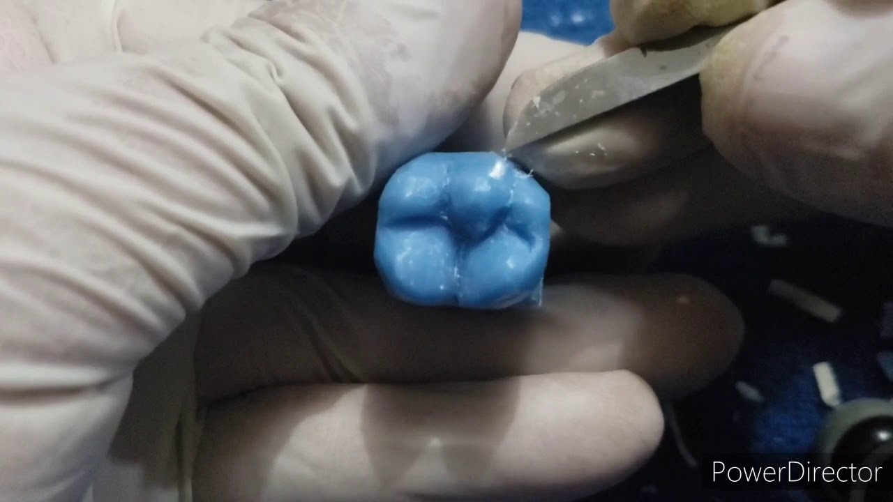 Tallado , Primer molar inferior