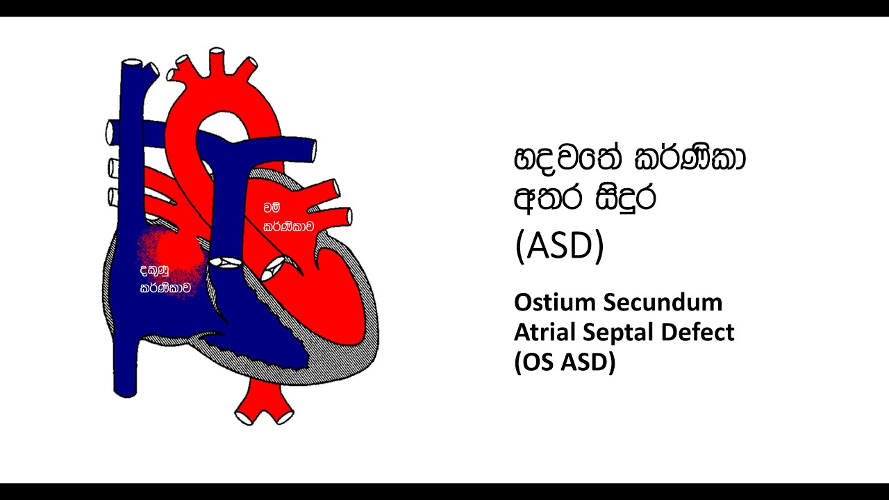 03. හදවතේ කර්ණිකා අතර ඇති ASD නම් සිදුර ගැන ඔබ දැන ගත යුතු දේ (ASD 1වන කොටස)