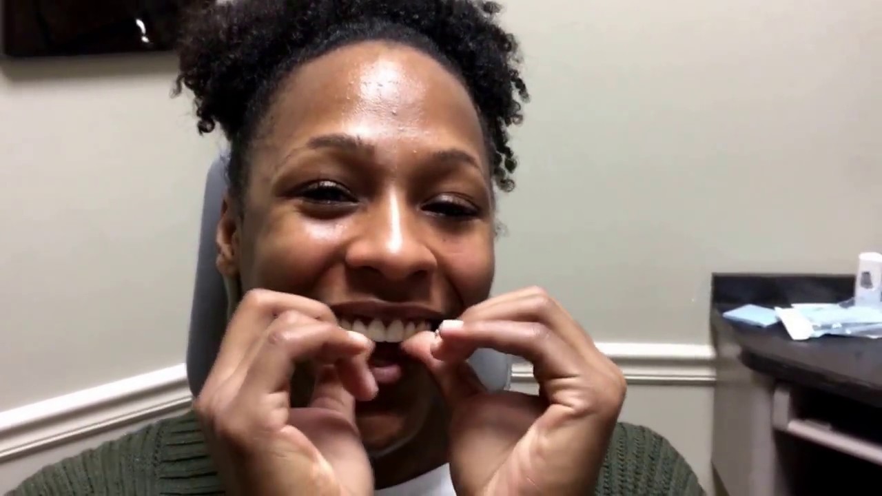 Snap-on Smile review...How does it fit? Well...watch to find out:)
