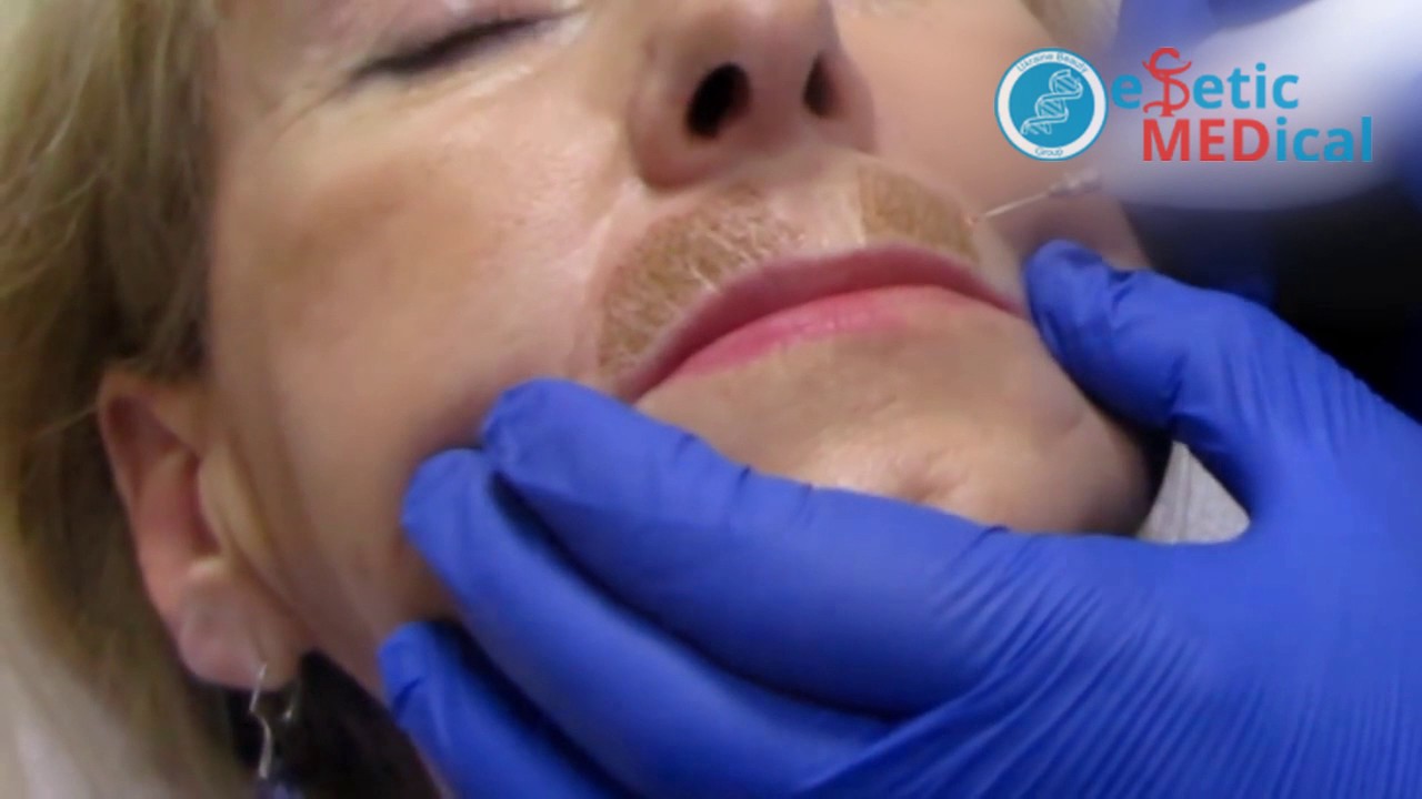 Плазменное омоложение Ablase PlexR Одесса Estetic Medical