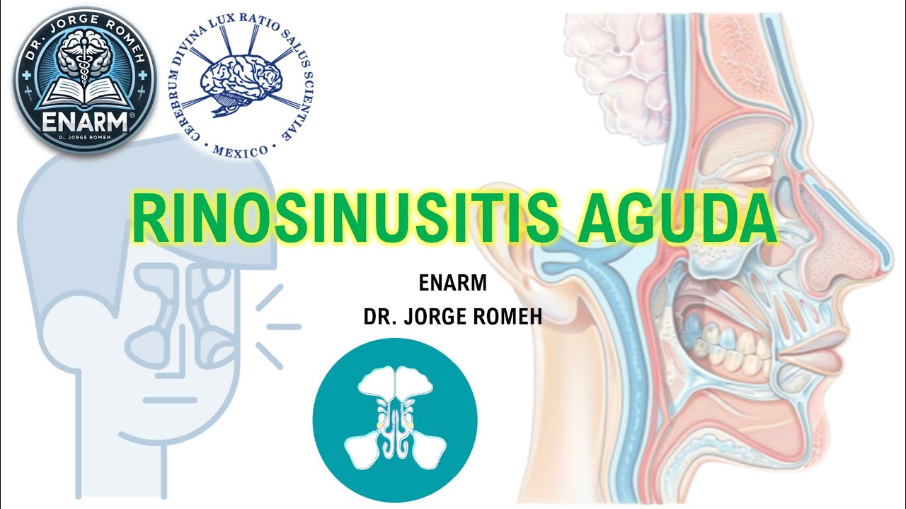 RINOSINUSITIS AGUDA EN PEDIATRIA - ENARM - TODO LO QUE DEBES SABER