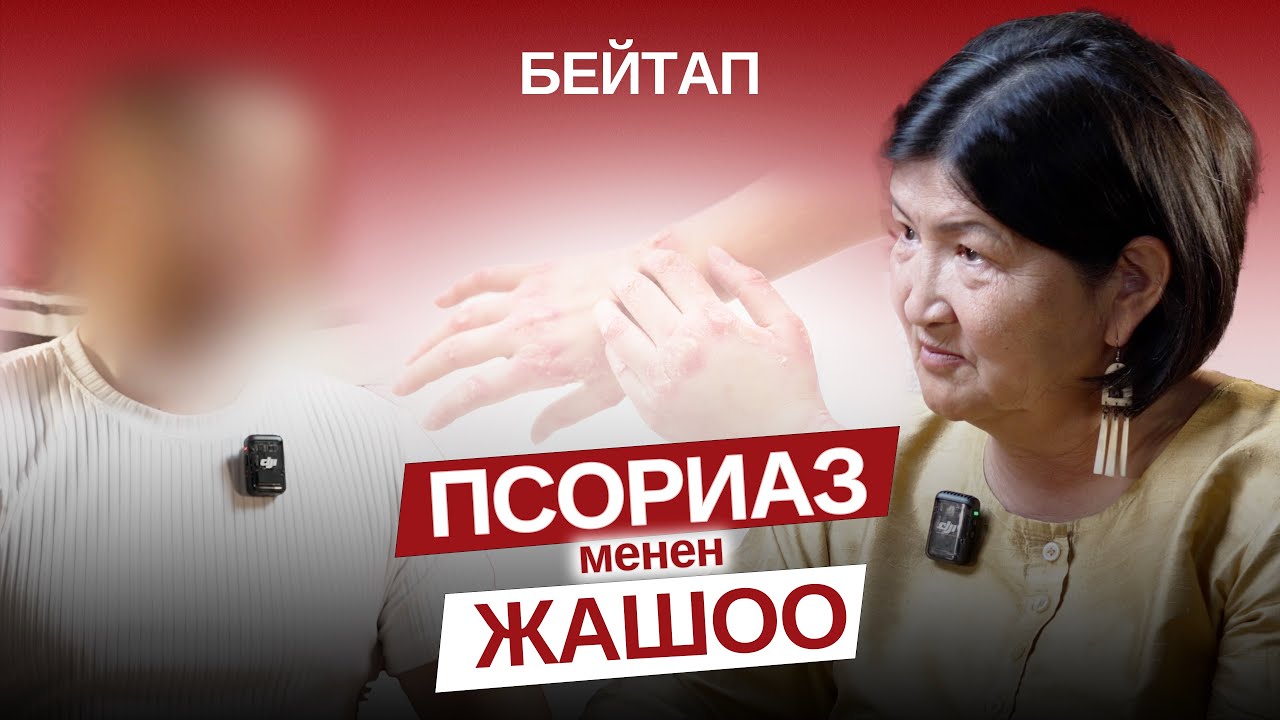 Псориаз менен жашоо.