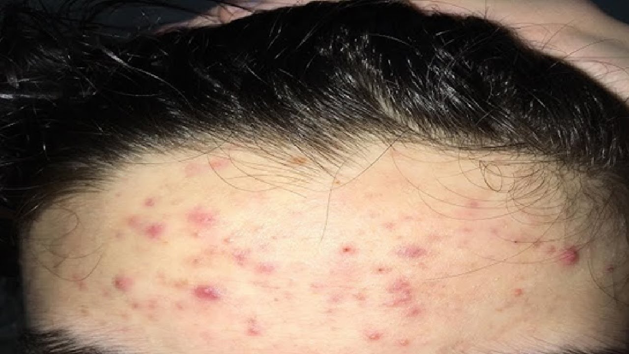 КАК ИЗБАВИТЬСЯ ОТ ПРЫЩЕЙ НА ЛБУ ЗА 1 ЧАС