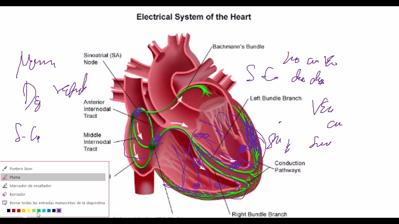 Fibrilación Ventricular  Explicación Detallada