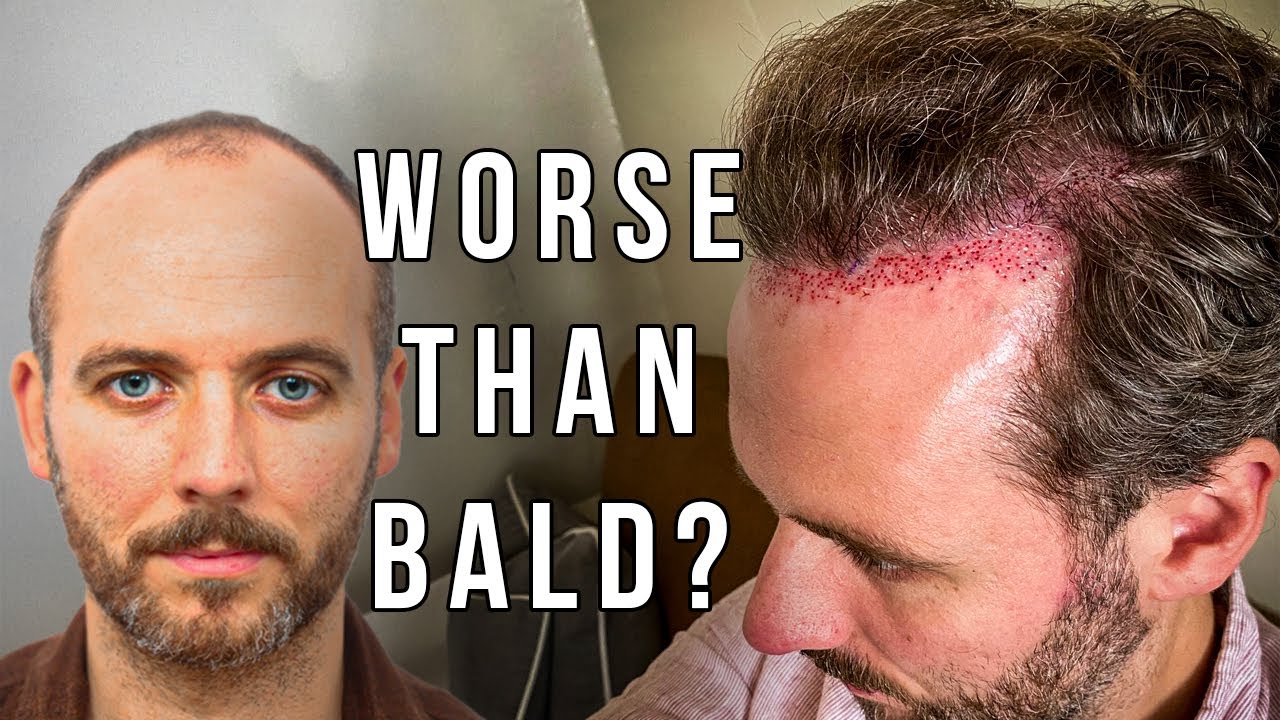 The Hair Transplant Industry Has a Serious Problem (Patient Advisor Speaks Out)