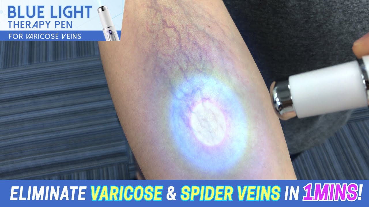 Blue Light Therapy Pen for Varicose Veins