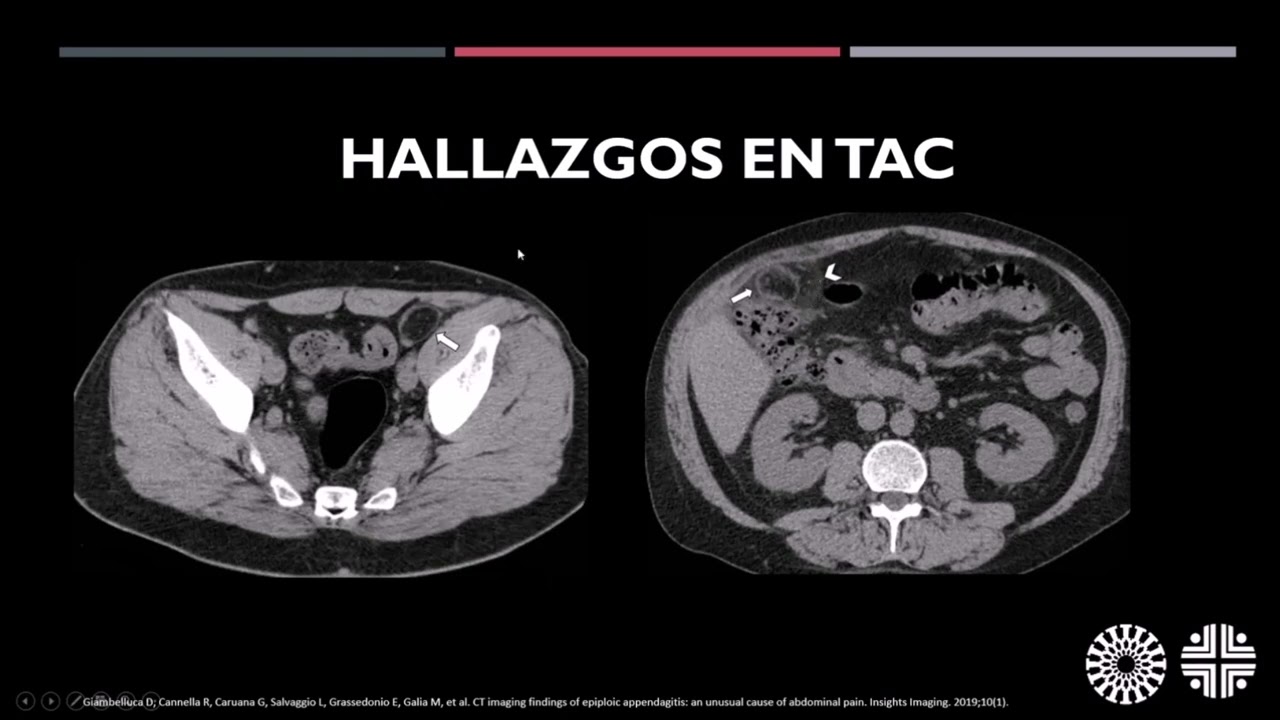 Caso Clínico 82: Apendagitis.