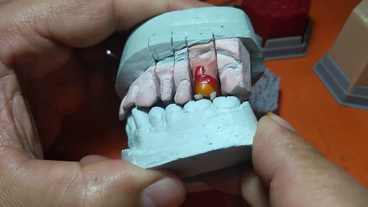 Encerado de corona Veener