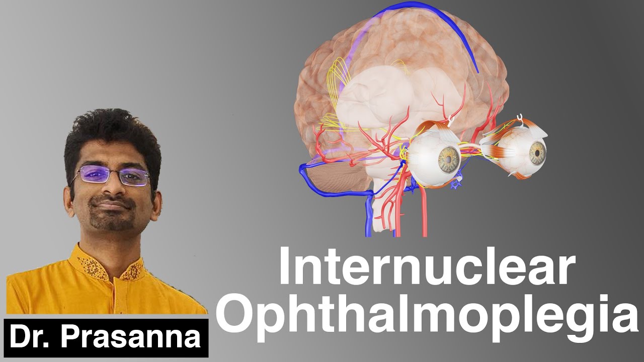 Internuclear Ophthalmoplegia