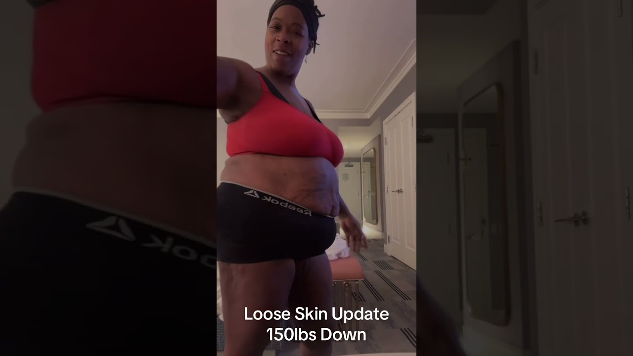 Loose skin update 160lbs down! #weightloss #vsg #looseskin #update