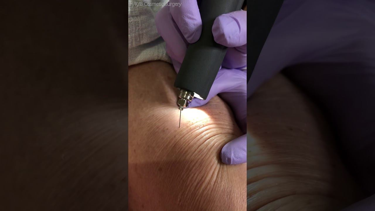 Non-surgical Skin Tightening with Subnovvii Plasma Pen