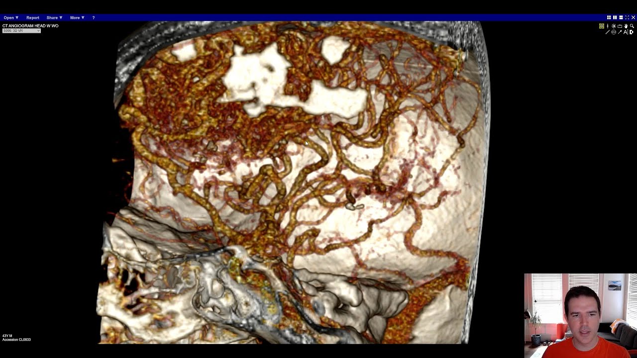 Vascular Imaging of the Head and Neck - Case C